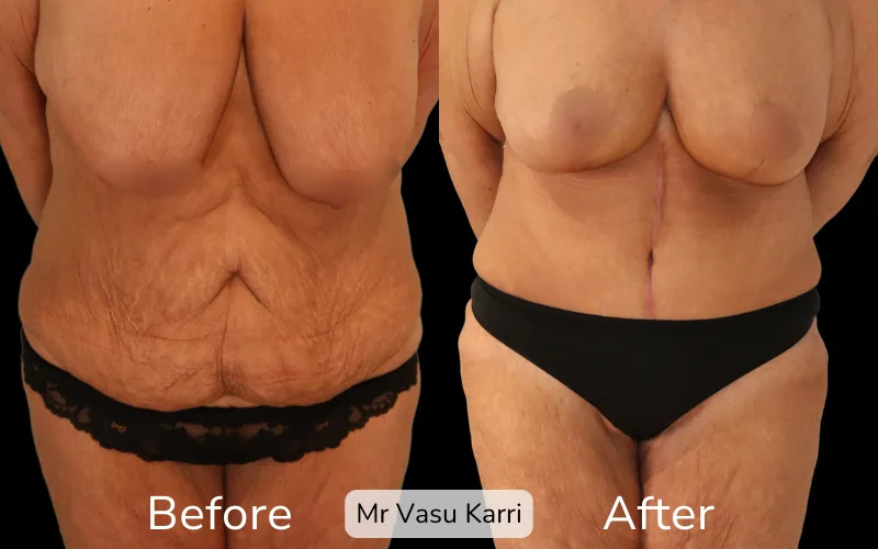 Before and after Tummy Tuck, patient fdl-2