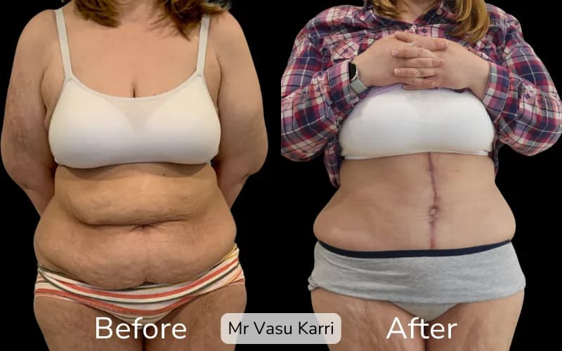 Before and after Tummy Tuck, patient fdl-3