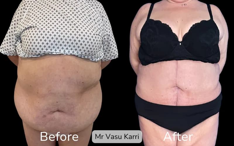 Before and after Tummy Tuck, patient fdl-4