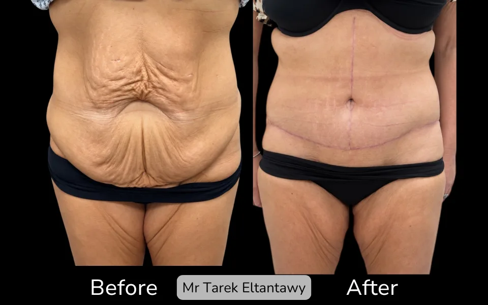 Before and after Tummy Tuck, patient fdl-5