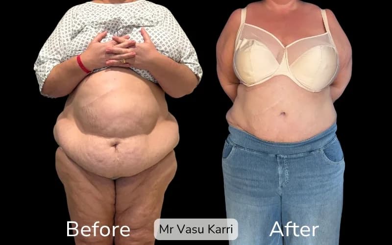 Before and after Tummy Tuck, patient tt-0.9