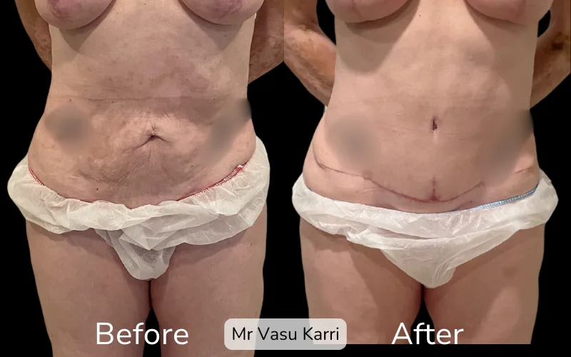 Before and after Tummy Tuck, patient tt-21