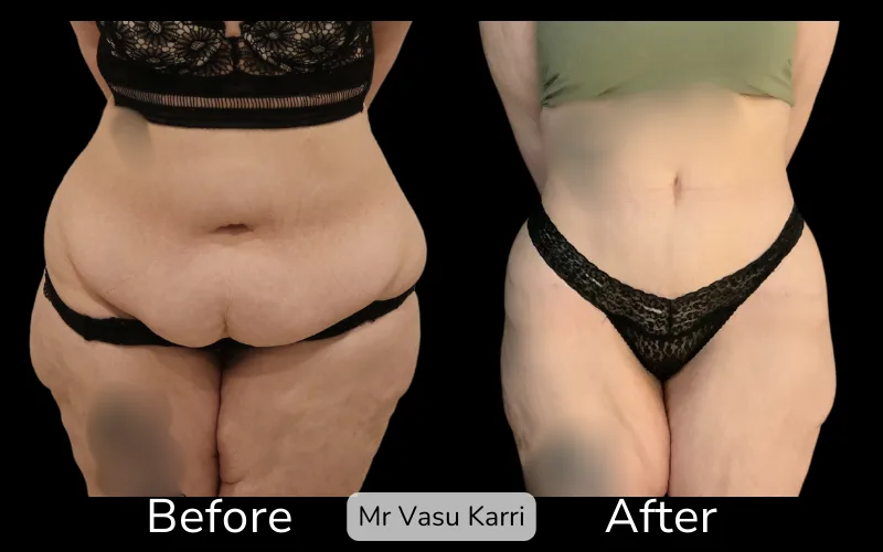 Before and after Tummy Tuck, patient tt-1
