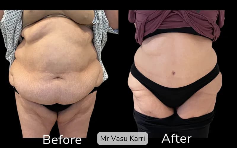 Before and after Tummy Tuck, patient tt-11