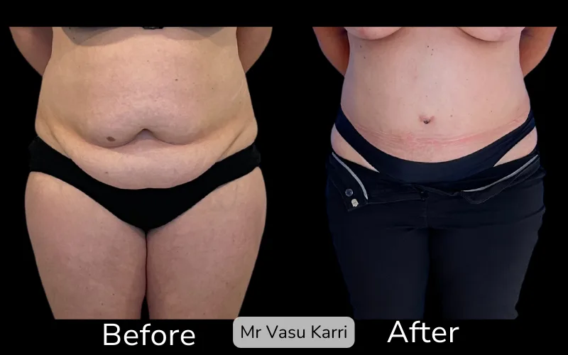 Before and after Tummy Tuck, patient tt-15