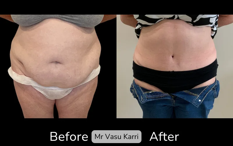 Before and after Tummy Tuck, patient tt-16