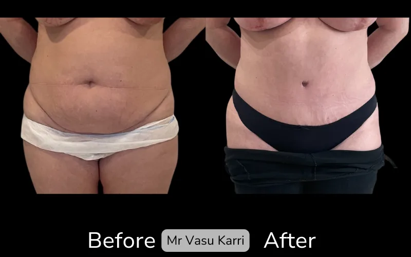 Before and after Tummy Tuck, patient tt-17