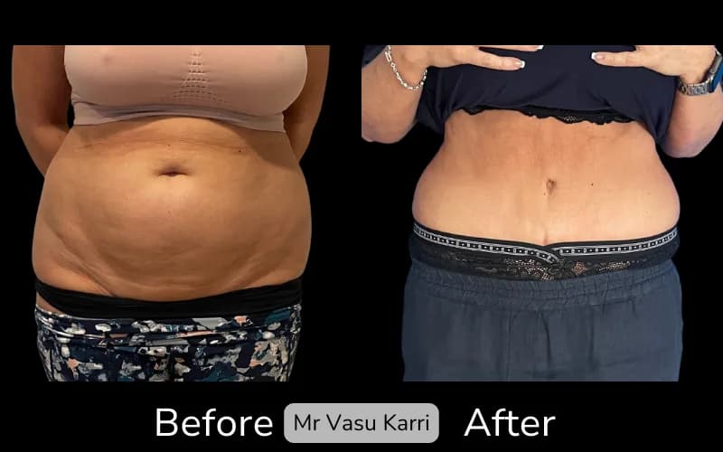 Before and after Tummy Tuck, patient tt-18