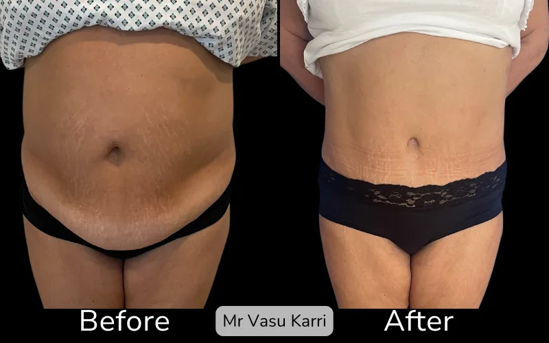 Before and after Tummy Tuck, patient tt-23