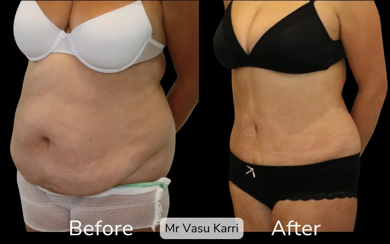 Before and after Tummy Tuck, patient tt-3