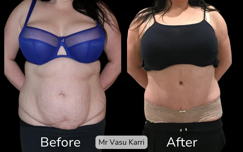 Before and after Tummy Tuck, patient tt-5
