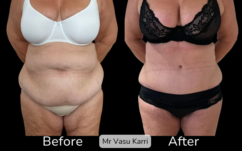 Before and after Tummy Tuck, patient tt-6