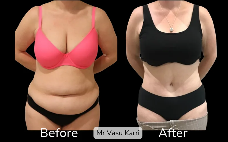 Before and after Tummy Tuck, patient tt-7