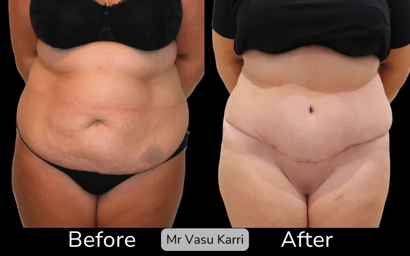 Before and after Tummy Tuck, patient tt-8