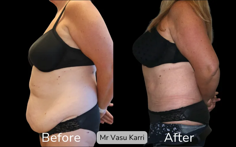 Before and after Tummy Tuck, patient tt-9