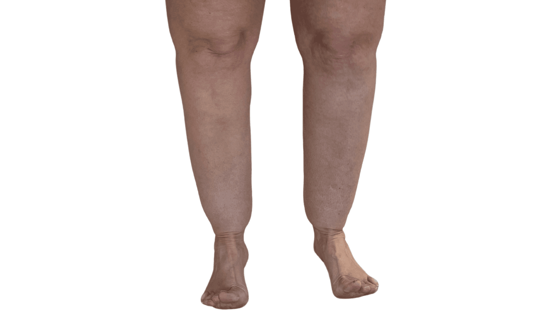 Lipoedema Surgery