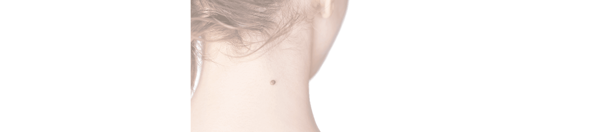 Scar Revision Surgery in Rotherham