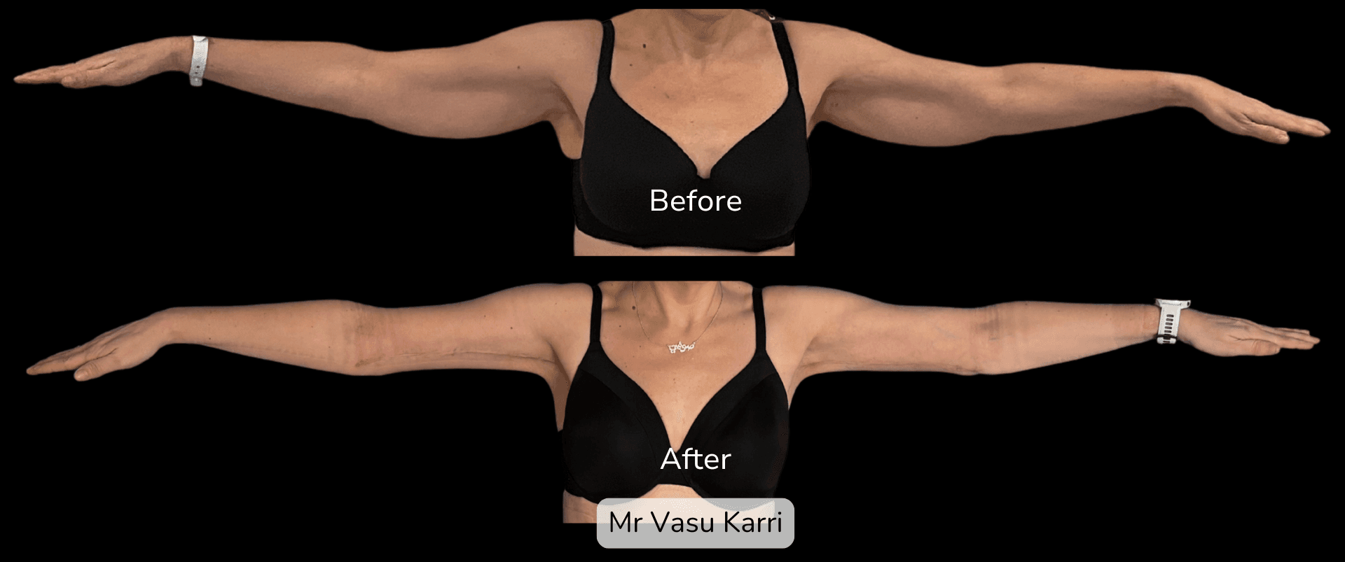 Arm Reduction (Bingo Wings) before and after