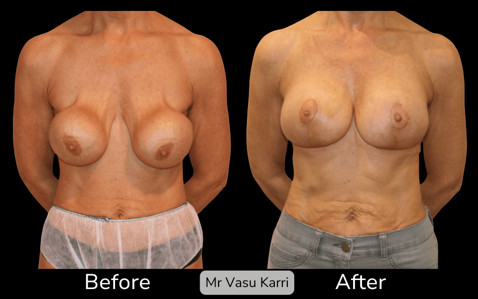 Breast Capsular Contracture Surgery in Rotherham Before & After 1