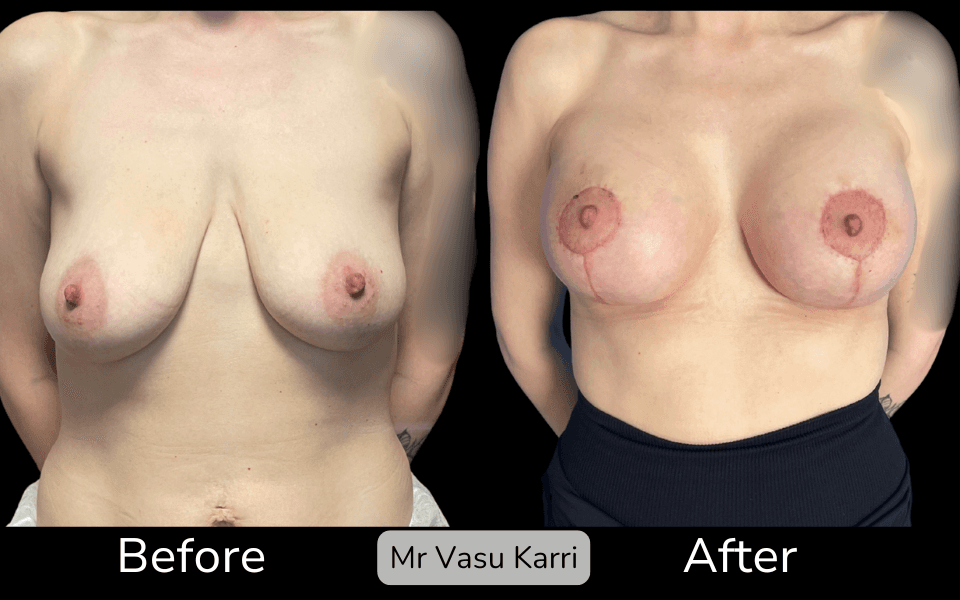 Breast Enlargement & Lift in Rotherham Before & After 1
