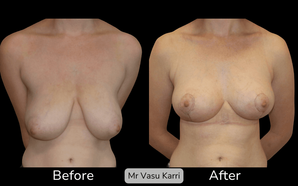 Breast Lift Surgery in Rotherham Before & After 1