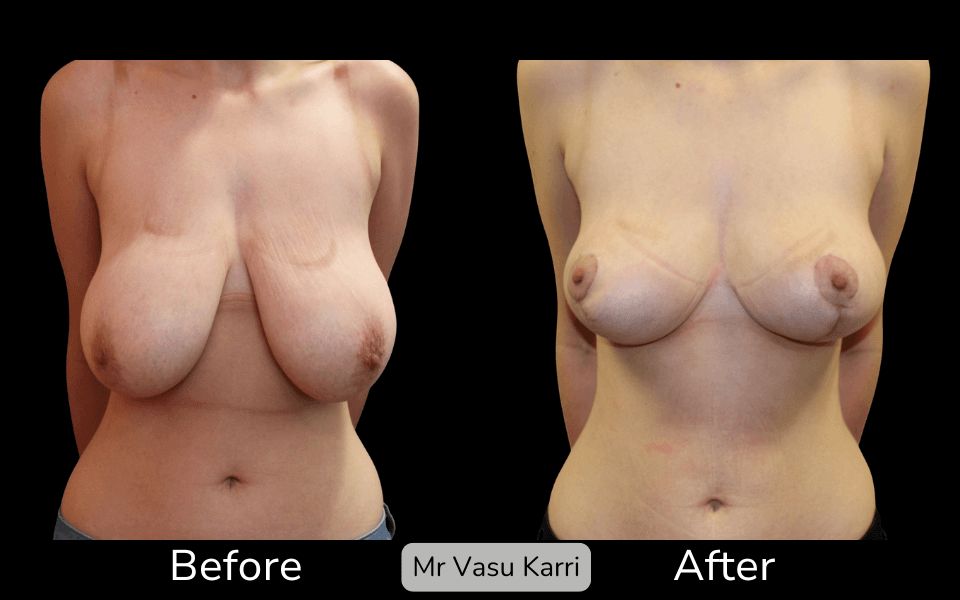 Breast Lift Surgery in Rotherham Before & After 2