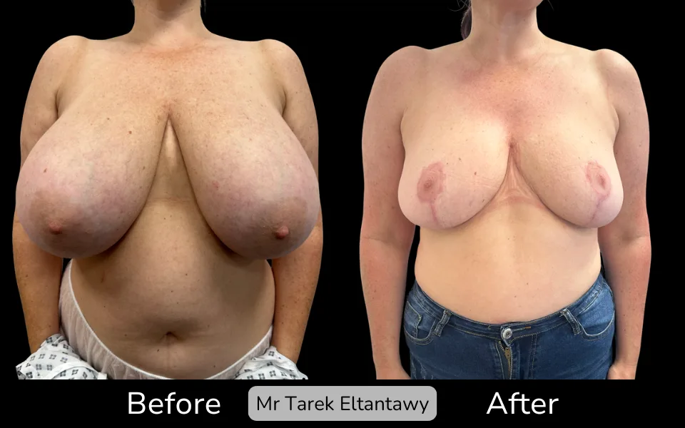 Before and after Breast Reduction, patient 23