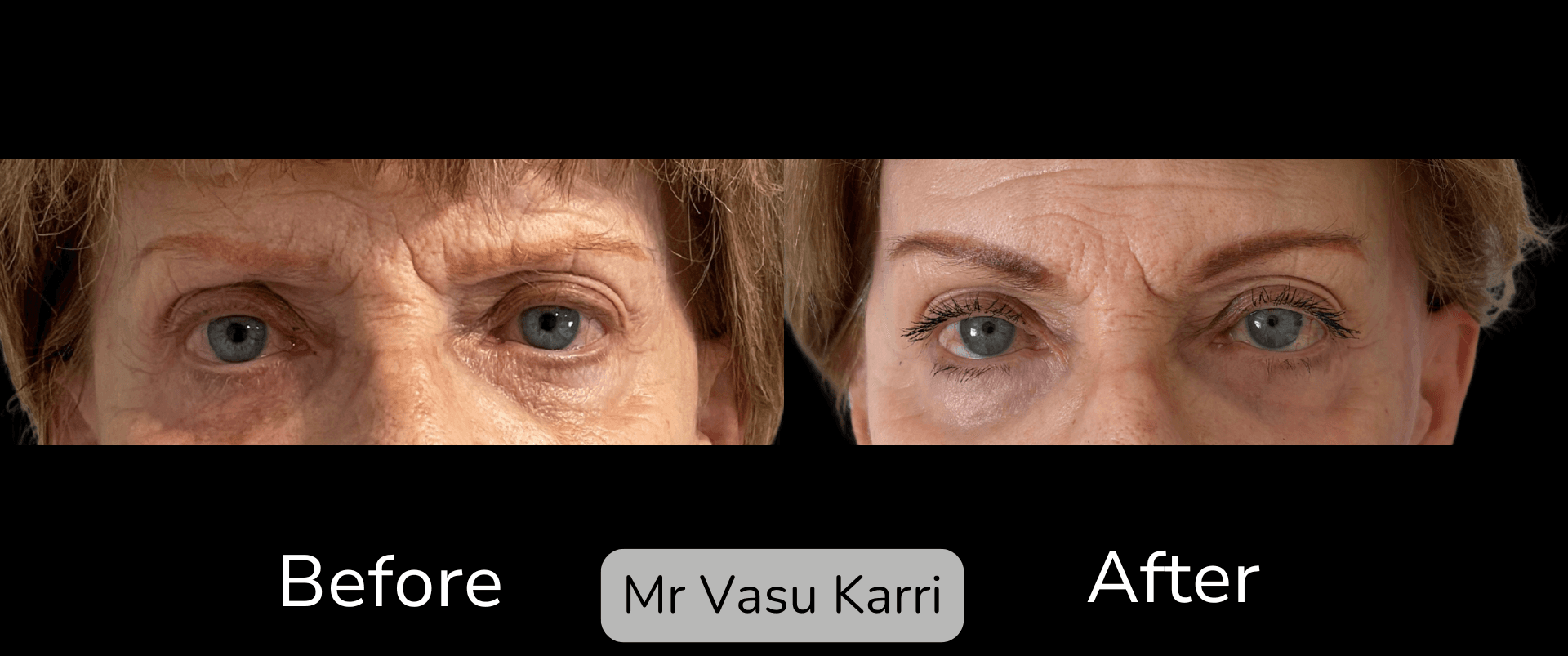 Brow Lift before and after