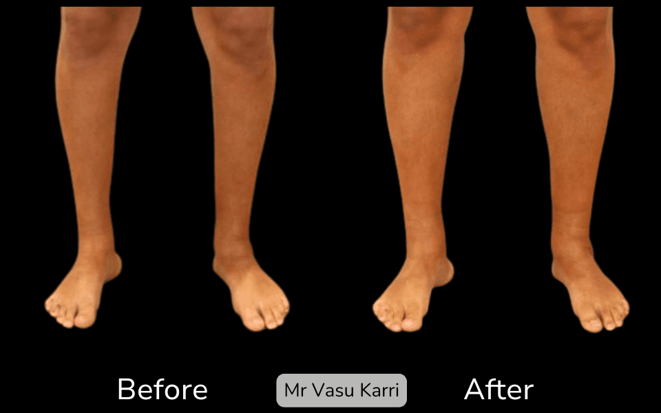 Calf Implants Surgery in Rotherham Before & After 2