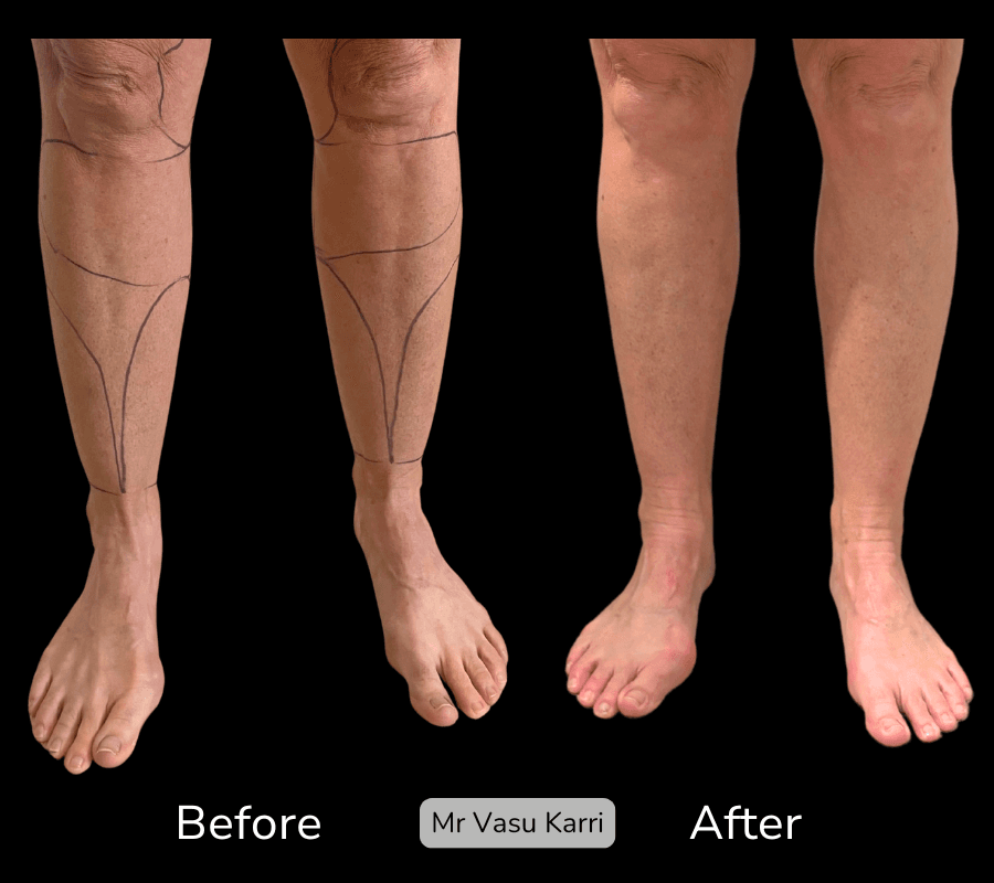 Cankle Surgery, before and after