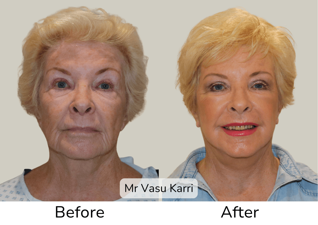 Phenol Skin Peel in Rotherham Before & After 3