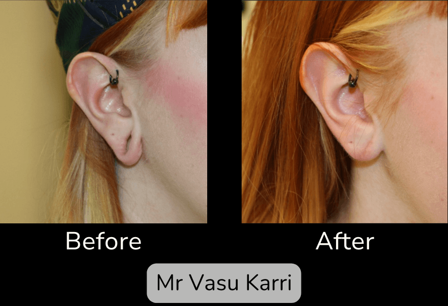 Earlobe Repair before and after