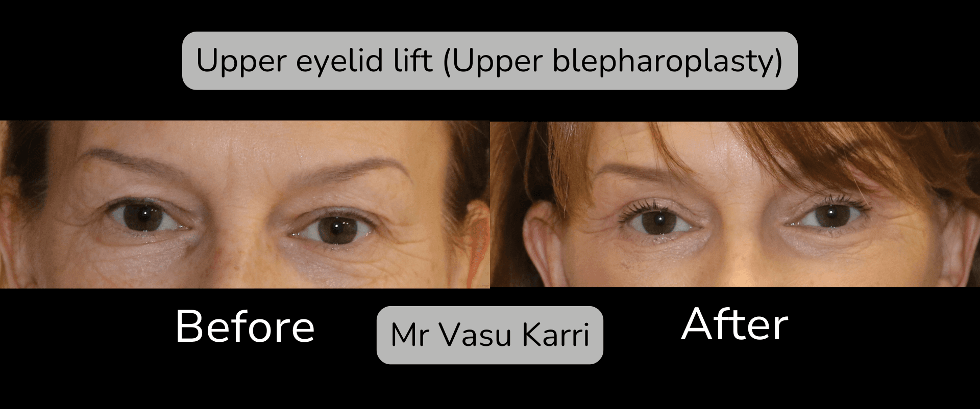 Upper Eyelid Lift Surgery in Rotherham Before & After 2