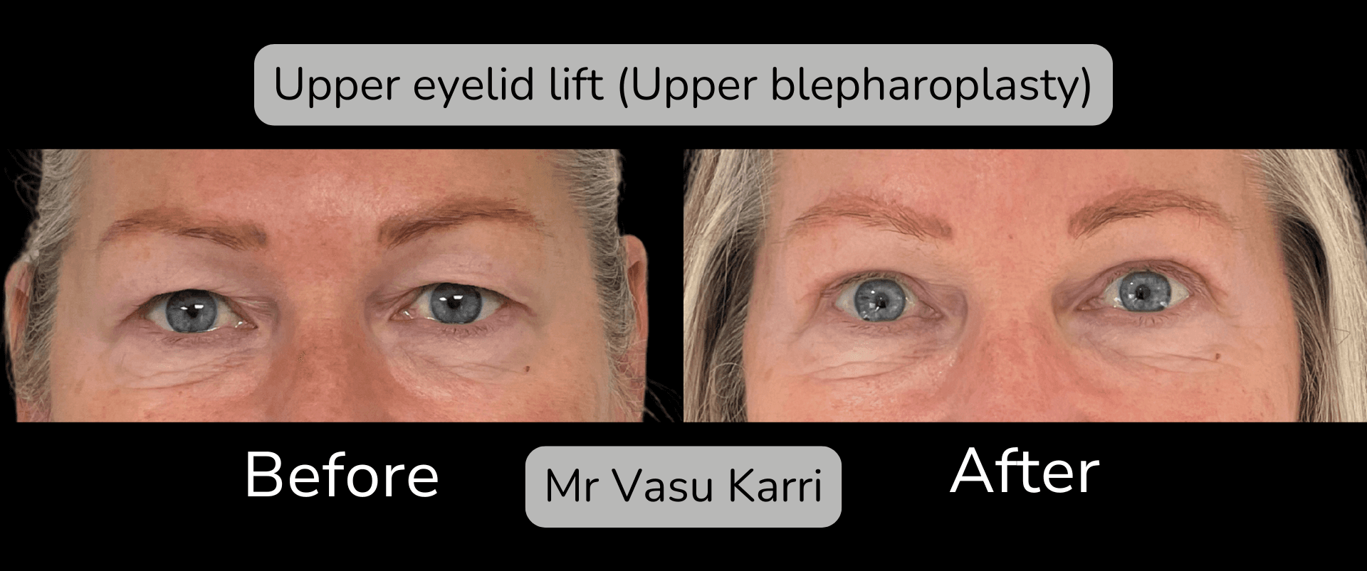 Upper Eyelid Lift Surgery in Rotherham Before & After 3