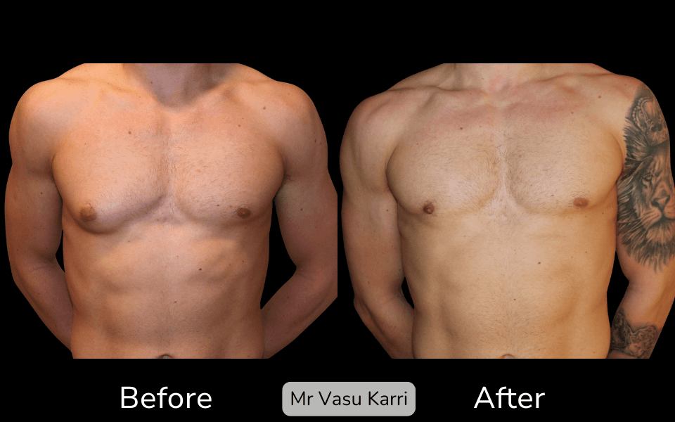 Male Breast Reduction Surgery in Rotherham Before & After 3