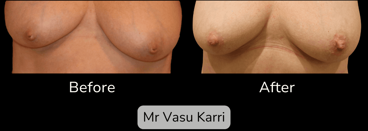 Inverted Nipple Correction in Rotherham Before & After 1