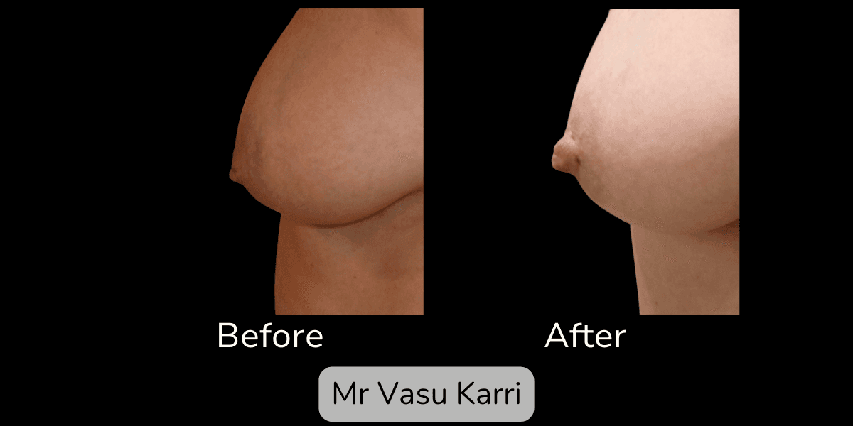 Inverted Nipple Correction in Rotherham Before & After 2
