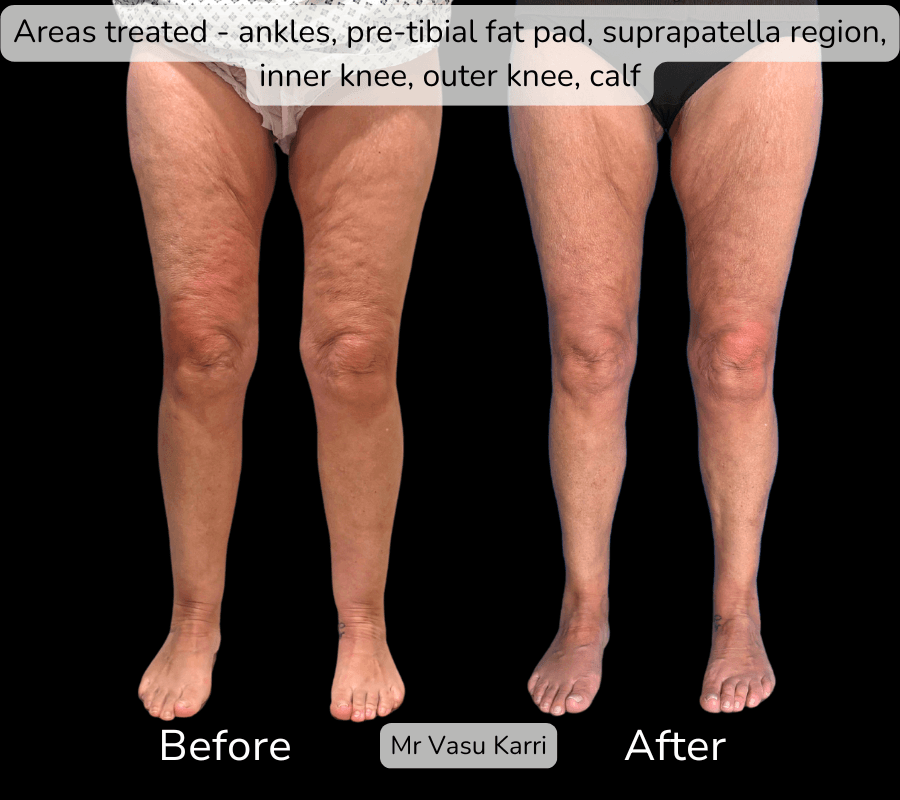 Stage 1 Lipoedema Surgery, before and after