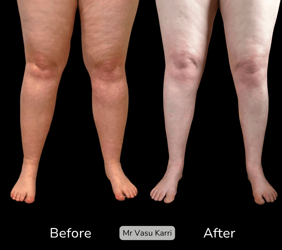 Stage 2 Lipoedema Surgery, before and after