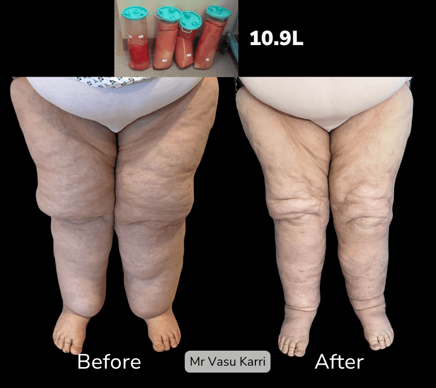 Stage 3 Lipoedema Surgery, before and after