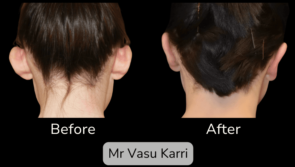 Prominent Ear Correction Surgery in Rotherham Before & After 3