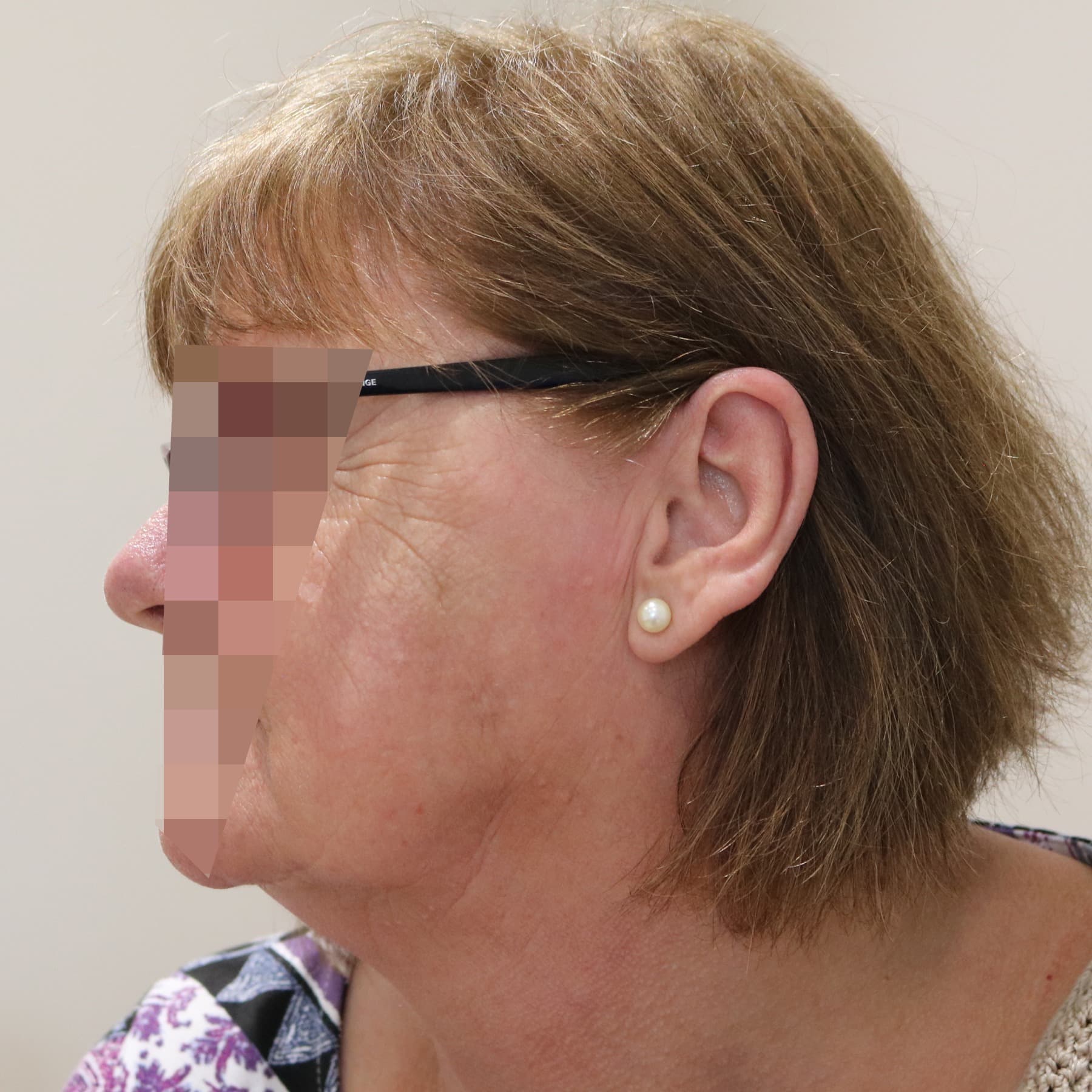 Scar Revision Surgery in Rotherham Before & After 1