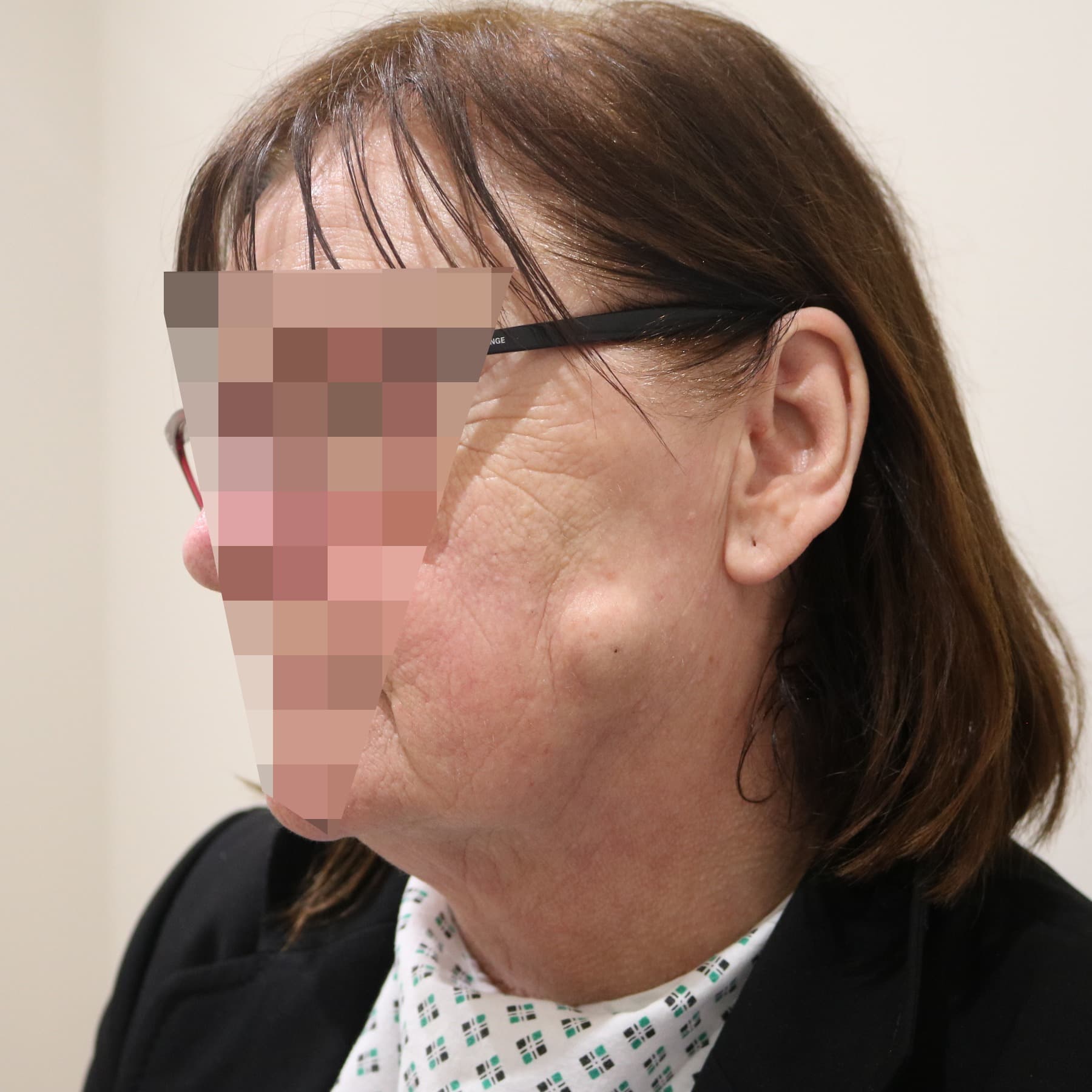 Scar Revision Surgery in Rotherham Before & After 2