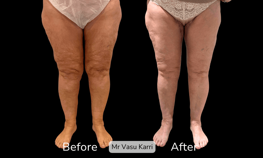 Thigh Lift in Rotherham Before & After 1
