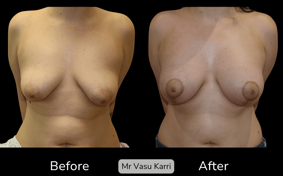Tuberous Breast Surgery in Rotherham Before & After 3