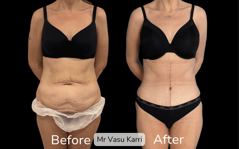 Fleur-de-Lis Tummy Tuck Surgery in Rotherham Before & After 1