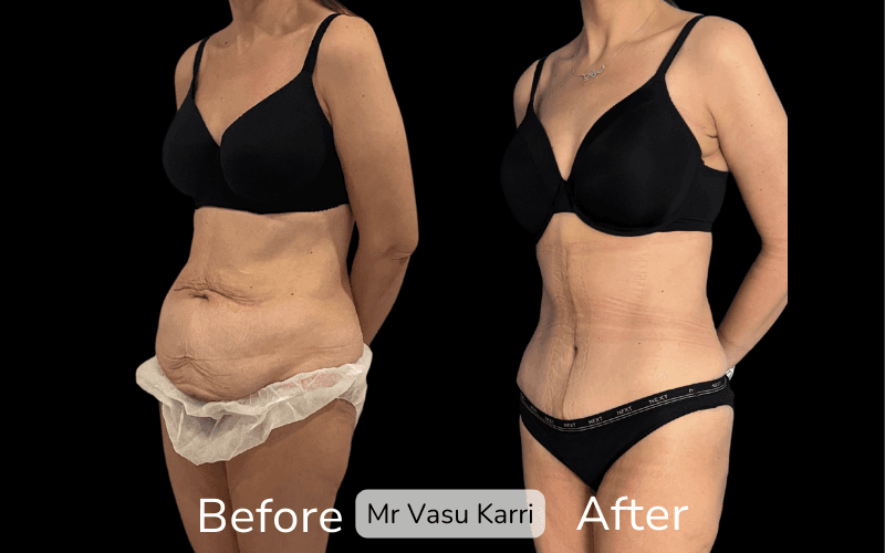 Fleur-de-Lis Tummy Tuck Surgery in Rotherham Before & After 2