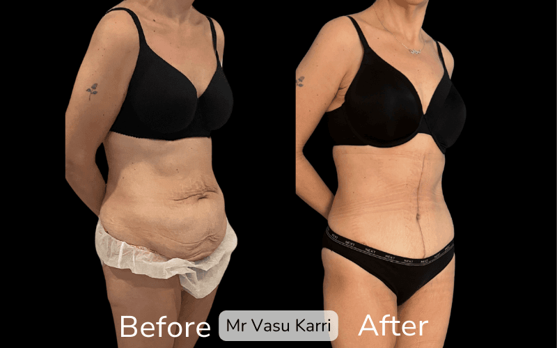 Fleur-de-Lis Tummy Tuck Surgery in Rotherham Before & After 3