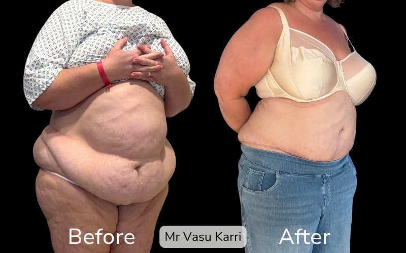 Buttock Lift Surgery in Rotherham Before & After 3