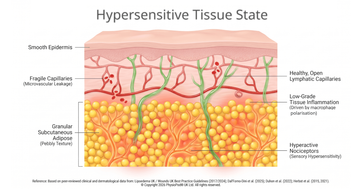 A medical diagram illustrating a hypersensitive tissue state. It shows a skin cross-section with a smooth surface, fragile leaking capillaries, a granular fat texture, low-grade inflammation, and hyperactive nerve endings.
